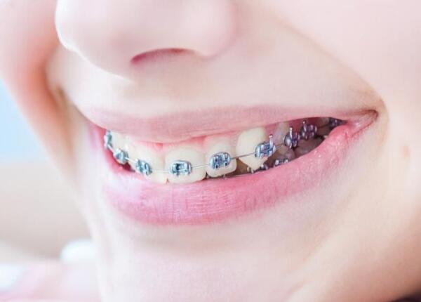 戴了牙套可以用電動牙刷嗎