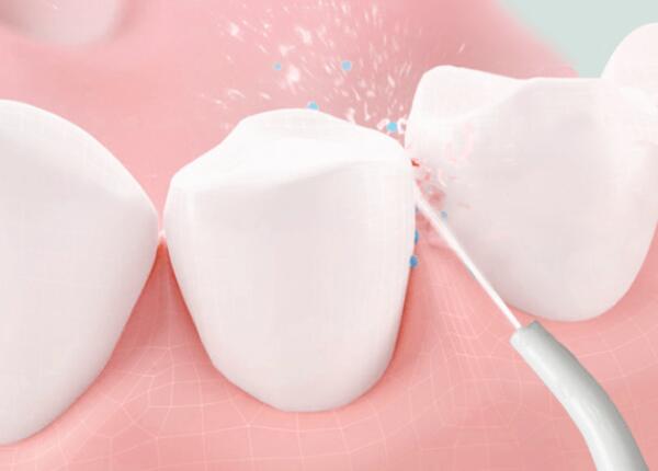 洗牙后用洗牙器好還是電動牙刷？口腔清潔工具這樣選！