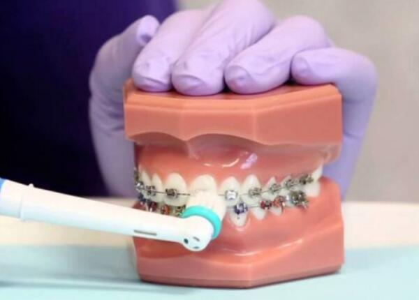 戴了牙套怎么使用電動(dòng)牙刷？正確使用牙刷很重要