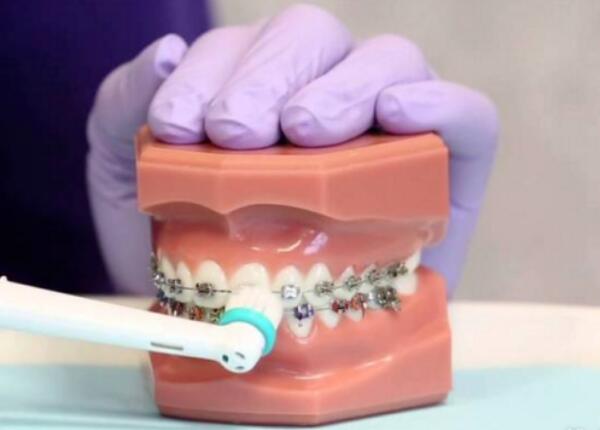 卸了牙套能用電動牙刷嗎？答案就在這篇文章